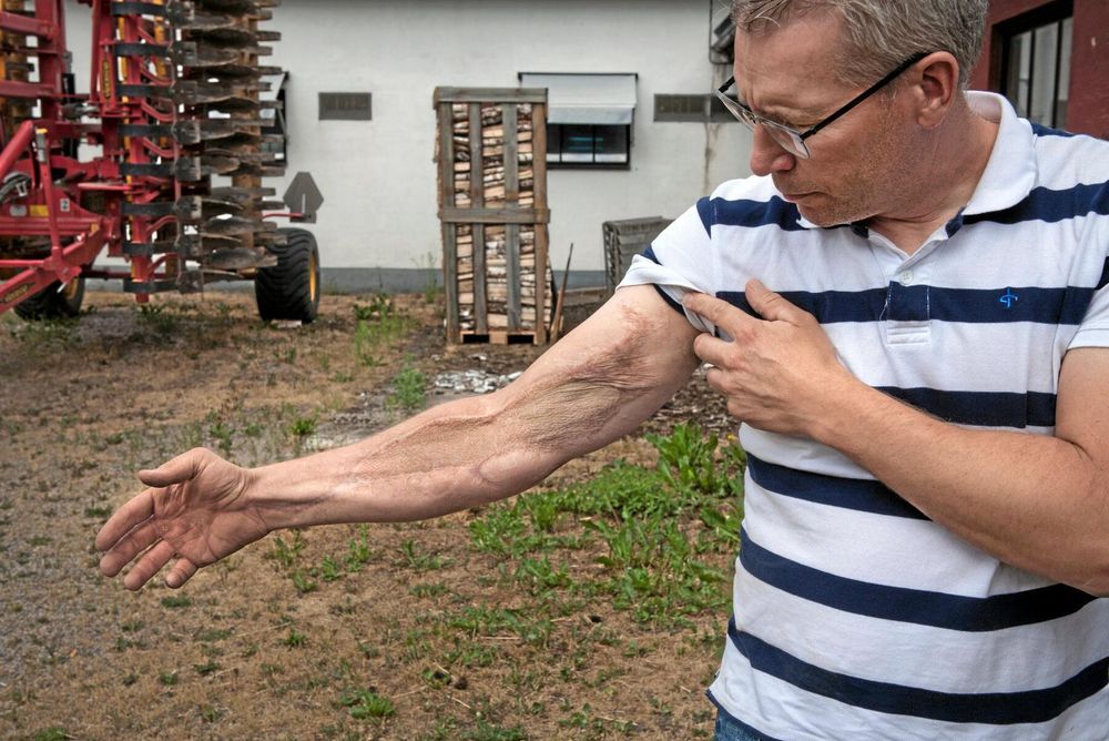 Marcus Trellman fastnade i potatisplockarmaskinen. Vägen tillbaka har varit lång.
